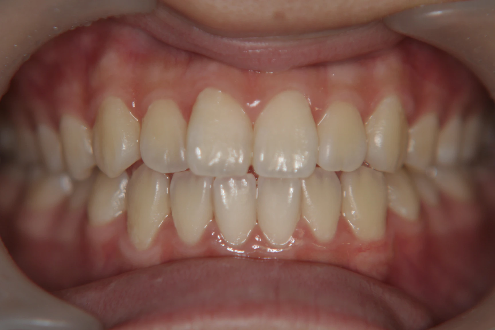 Before